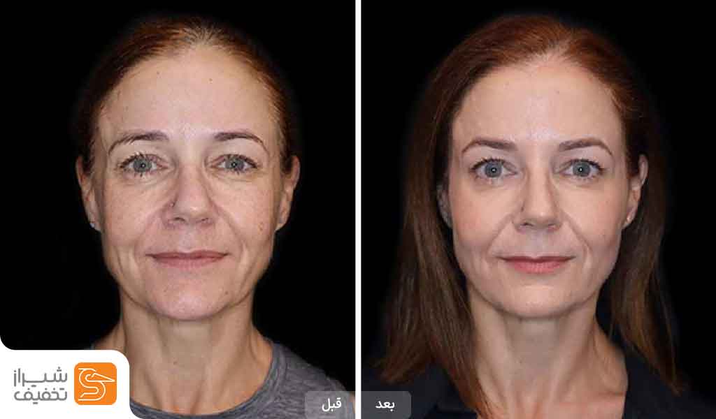 عکس قبل و بعد پلاژن تراپی در شیراز